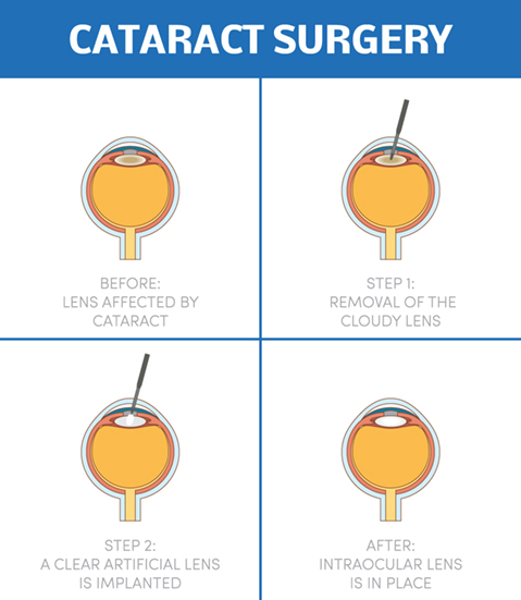 Cataract Surgery steps illustration